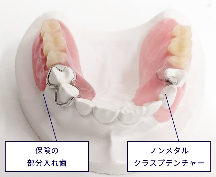 エステショットブライトノンメタルクラスプデンチャー